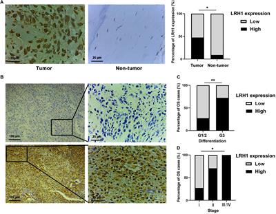 LRH1 Acts as an Oncogenic Driver in Human Osteosarcoma and Pan-Cancer